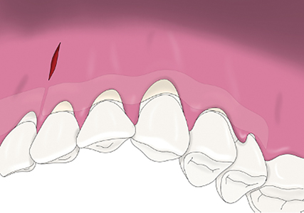 . The inserted allograft was manipulated into position to cover the exposed root surfaces up to the CEJ.  
