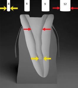  Increase in bonding interface when using a bundle of multi-post, compared to the one in a central post.
