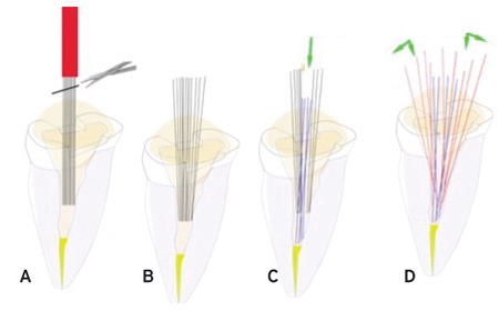 17A. Cut the sheath with scissors.  17B. The bundle of strands will fill the available space, regardless of the shape.  17C. Push the strands in the center toward the apex.  17D. Spread the rest of the strands as peripheral as possible.