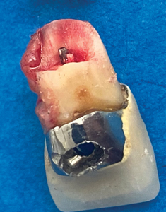  prefabricated post restoration fills the available canal space without requiring a shaping thus weakening the residual tissues. A flexible post can adapt to a curvature of the dental canal.