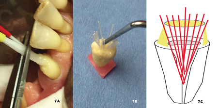 . After the scissors cut the sheath, the individual micro-posts are freely distributed in the available space to create a continuous fibro-architectural network from the root to the crown. Their organization can be aided with a simple probe prior to the polymerization of the adhesive composite, and they can be effectively distributed throughout the entire reconstruction.
