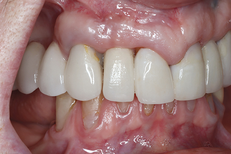 Frontal view and retracted lateral view of the ISC 12 at initial presentation. Note open distal contact.