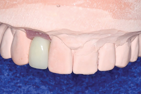  Definitive ISC 12 on the master cast and in the mouth. 
