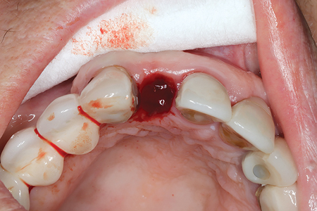  Peri-implant soft tissue inflammation and bleeding observed upon removal the ISC 12.