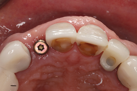  One month follow-up after removal of the ISC and placement of the straight healing abutment.  A. & B. No soft tissue inflammation observed in the 12 site