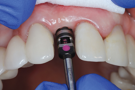 . Confirming no bony interference for impression coping and planned restoration using bone mill drill and its guide pin advanced passively by hand (not in a handpiece)