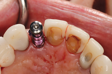 B. Impression coping was adjusted to avoid binding with the adjacent tooth (11).  8A&B. Frontal and lateral views of the screw-retained provisional ISC