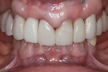 . Frontal and lateral views of the screw-retained provisional ISC 12 immediately after insertion.