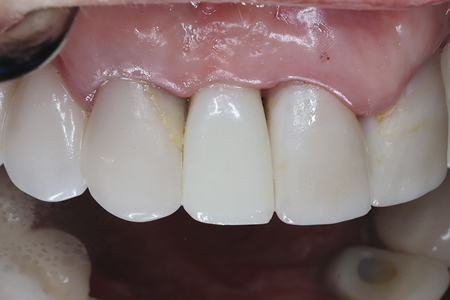 . Frontal and lateral views of the screw-retained provisional ISC 12 immediately after insertion.