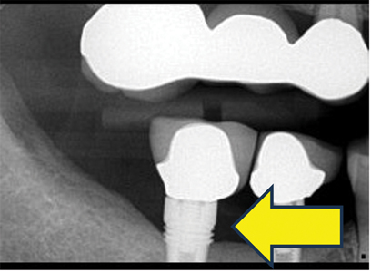 Radiographic bone loss. 