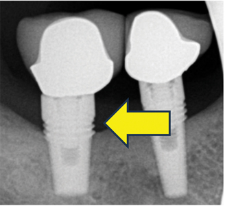 Radiographic bone loss. 