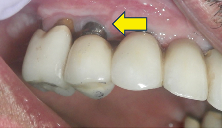 Advanced Peri-Implantitis with gingival inflammation. B. Advanced bone loss.  