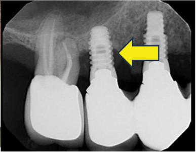 Advanced bone loss.  