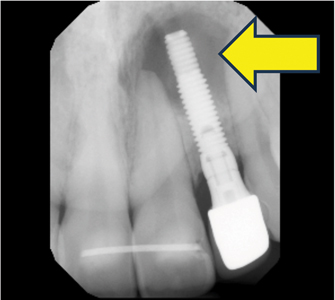 Retrograde Peri-Implantitis.