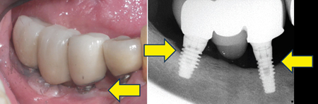 A. Early Stage Peri-Implantitis with gingival inflammation. B. Early bone loss.