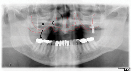 . Bone in the posterior maxilla is predominantly lost through two mechanisms. The first is absorption of the alveolar ridge after loss of the teeth and ongoing pneumatisation of the sinus. A. The available bone under the sinus becomes less robust. B. however the bone between the anterior sinus wall and the piriform aperture tends to maintain its dimensions