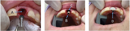 4A. To compensate for the circumferential remodelling of the anterior maxilla leading to thinning of the buccal aspect with age, implants should ideally be place closer to the palatal side of the ridge in the esthetic zone. B. In this immediately placed and loaded implant the osteotomy is well to the palatal of the root socket. C. The gap between the implant and facial tissues can be grafted to provide soft tissue support. D. The temporary abutment can be seen emerging on the palatal side of the provisional crown allowing for a screw retained prosthesis.