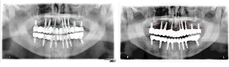  Alveolar bone without the influence of the periodontal ligament undergoes a greater degree of resorption over time than basal bone. Implants placed in alveolar bone have a greater risk of complications, particularly in full arch reconstructions. The radiograph on the left shows bone levels at the time of extraction and implant placement. The radiograph on the right is four years later.