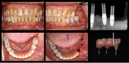 Initial presentation of the provisional IS-FDP with periapical radiograph of the implants 34, 35 and 36.