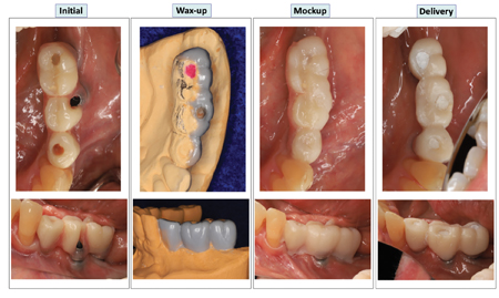 Modification of the provisional IS-FDP with diagnostic wax up, intraoral mock up and delivery of the optimized provisional prosthesis. 