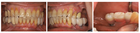 Further images of the modified provisional prosthesis.