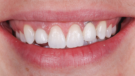 Patient’s smile after crown lengthening surgery – note that the gingival levels of #11
and #21 are even and much more appropriate when compared to the implants.