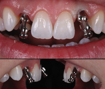 Impression copings placed to visualize the angulation of the current implants. Note the severe buccal proclination of the #22 implant.