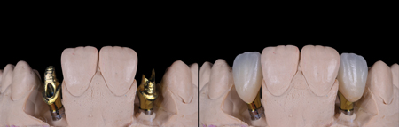 6A. Custom gold anodized titanium abutments. B. Porcelain layered zirconia crowns seated on top of the custom abutments 