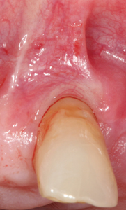  Pre-op photographs of frenectomy site.  