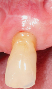  Pre-op photographs of frenectomy site.  