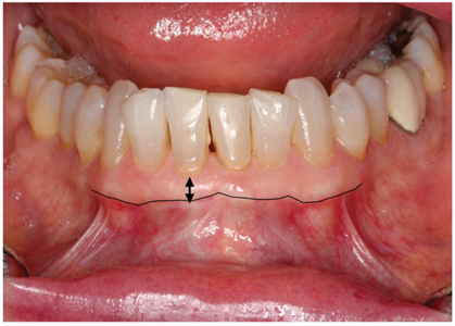 Pre-operative and 4-month post-operative clinical pictures.  
