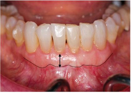 Pre-operative and 4-month post-operative clinical pictures.
