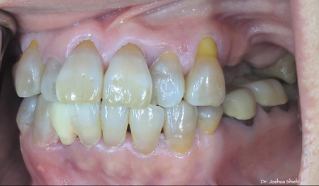 Clinical presentation of missing teeth.