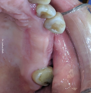 Fully healed palatal
donor site.