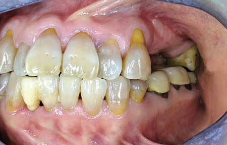 No more buccal frenal
pull - keratinised gingiva surrounding
the edentulous ridge