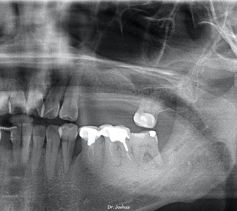 . Radiograph taken 6 months post sinus graft procedure showing well remodelled bone.  
