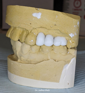 Close to optimal occlusion was set up with wax for pre-implant assessment