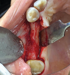  urgical exposure of the underlying irregular bony ridge.