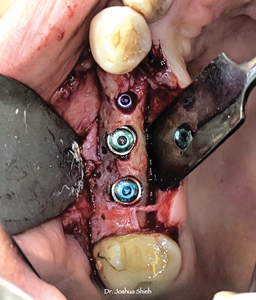. Fixtures placed at close to ideal 3D prosthetic positions.