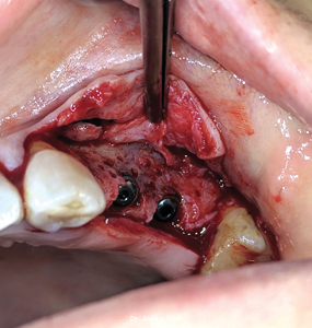 . Decortication was performed prior to the implant placement, observe thin buccal bone 
and implant thread exposure.  