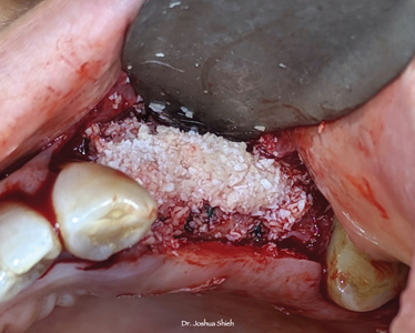 Mix of allograft and xenograft to augment the buccal bone contour. 