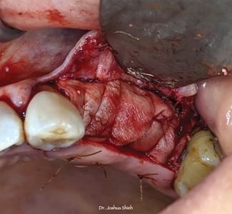 Buccal GBR technique secured with resorbable sutures.  