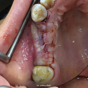 2 stage protocol was followed for simultaneous GBR and implant placement.