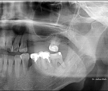 . Radiograph showing low lying sinus floor in the 25-26 region