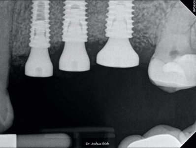 Passively seated healing abutments with positive bone above the platform of the implant fixtures.