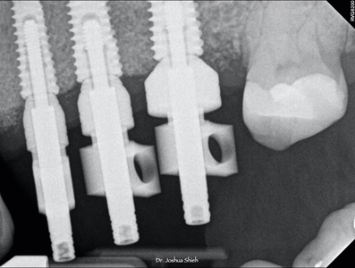 Radiograph confirming well seated impression copings.