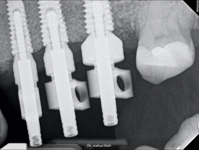 Radiograph confirming well seated impression copings.  