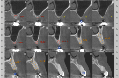 Coronal plane showing inadequate alveolar bone with a clear maxillary sinus.