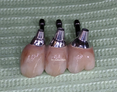 Splinted non hex PFM screw retained restoration.