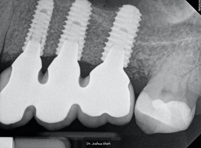 . Uniformly seated implant restorations.